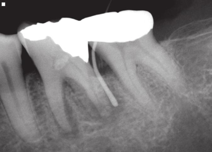 Treatment of primary endodontic lesions bone loss or vertical root fracture.