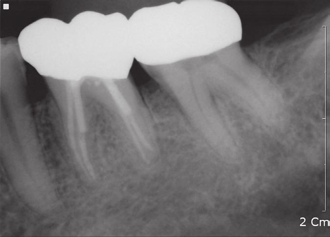 A periapical radiograph showed apical radiolucencies on both roots, and there was no alveolar bony support around the distal root (Figure 1a).