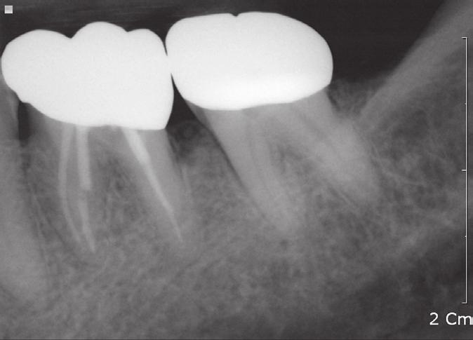 The possibility of root fracture was considered because of vertical bone loss, the large metallic restoration, and prior bite discomfort history.