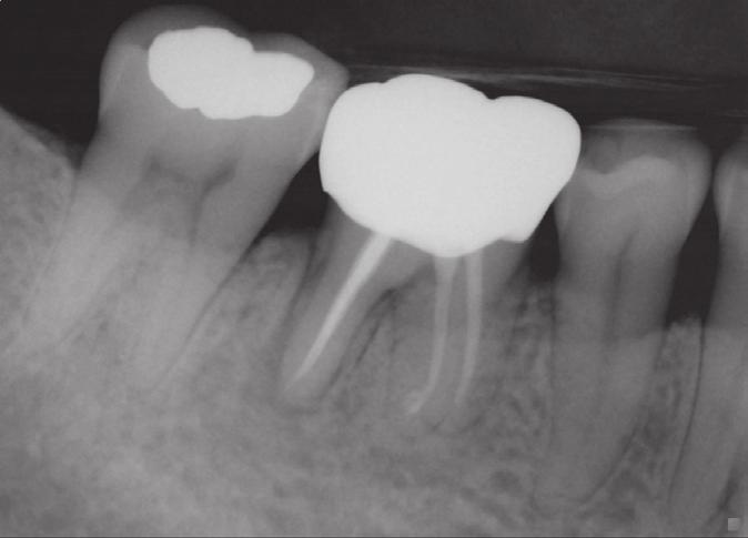 Lim JH et al. Case 2 A 43-year-old female patient visited our clinic because of intermittent discomfort of her right mandibular teeth.