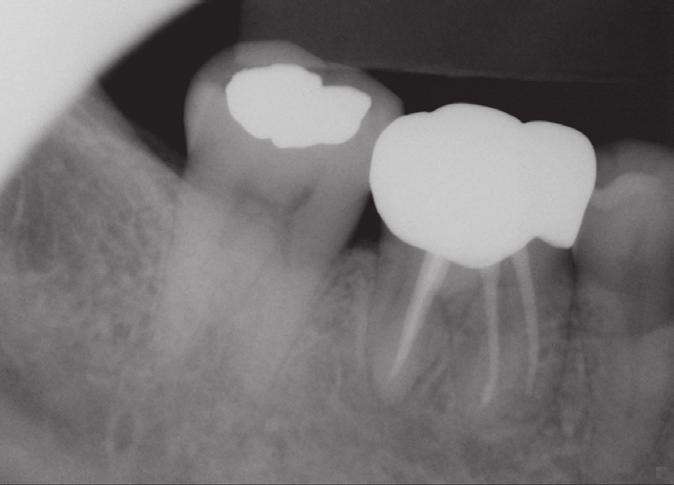 mesial root might be vertically fractured.