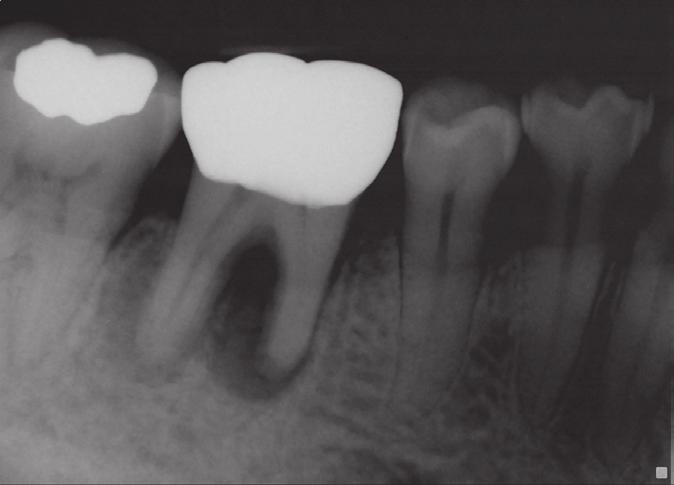 The tooth was sensitive to percussion and bite. There was no mobility, and periodontal probing was within normal limits.