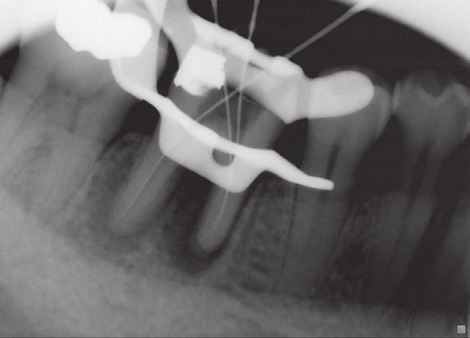 The tooth was diagnosed as a previously initiated tooth with chronic apical periodontitis.