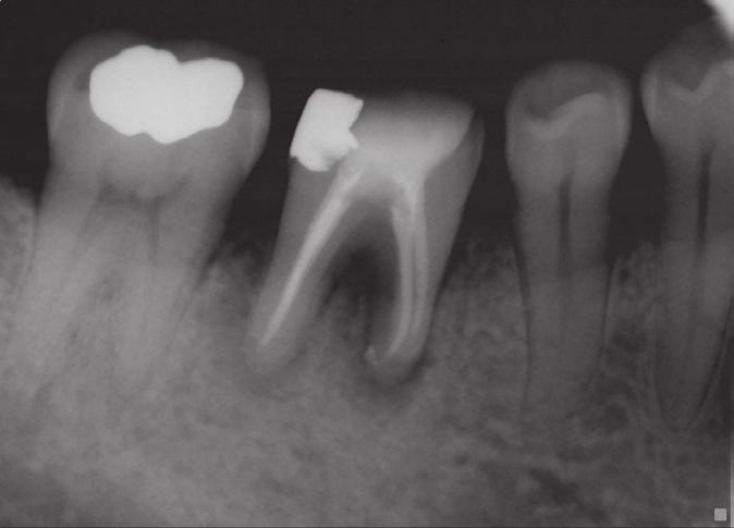 possible, so nonsurgical endodontic therapy was suggested as the first option. The gold crown and amalgam core were removed.