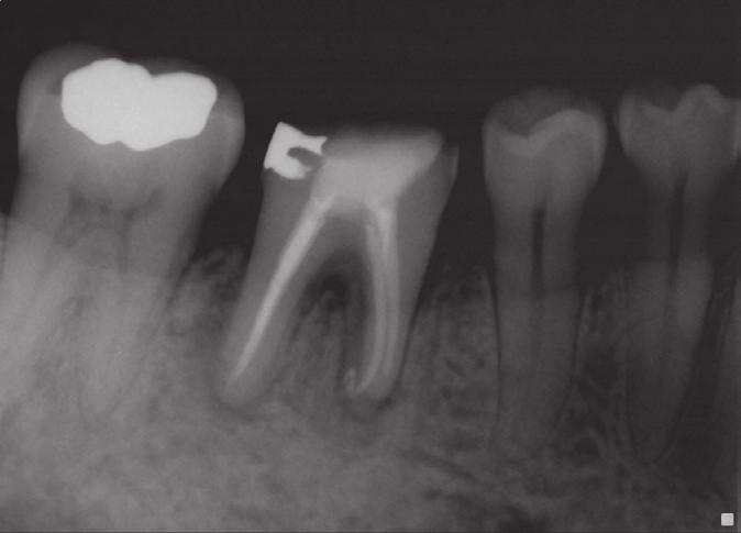 Conventional root canal treatment was performed using a protocol similar to that described in case 1.