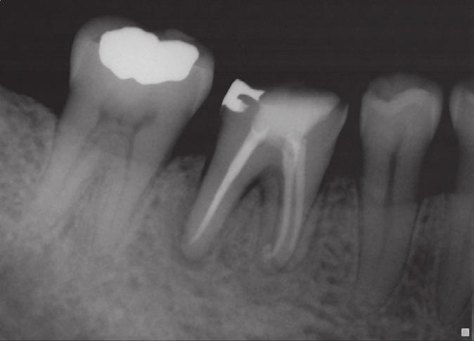 Periapical radiographs of case 2.