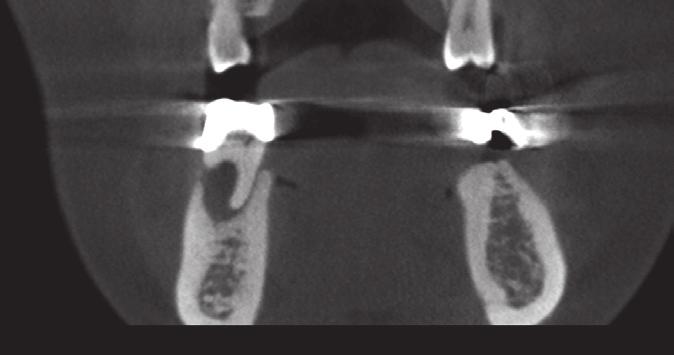 Treatment of primary endodontic lesions visit, the patient was asymptomatic, and the canals were clean. The canals were obturated, and a composite resin core was built (Figure 2d).