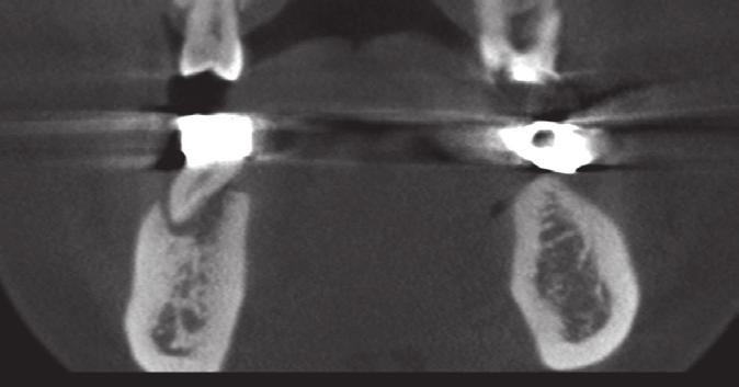 The tooth underwent routine check-ups and was asymptomatic through a 2-year follow up (Figures 2f - 2h).