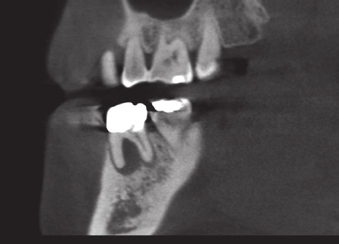 Her chief complaint was gingival swelling around the tooth. A sinus tract was traced to the distal aspect of the distal root (Figures 4a and 4b).