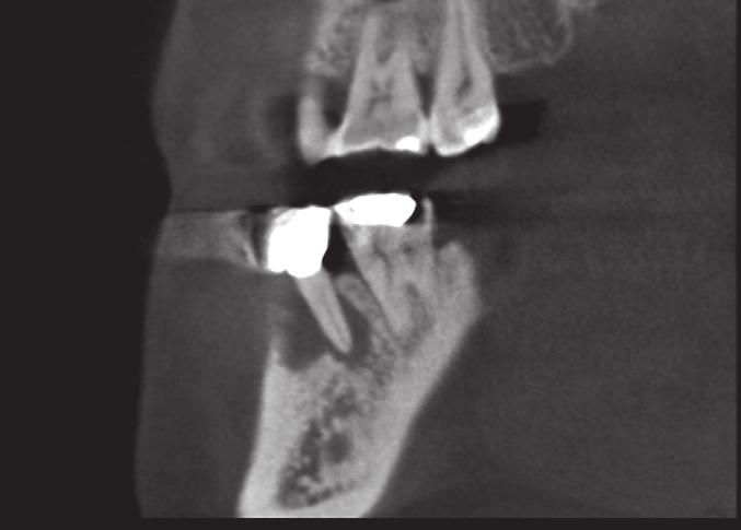 Her prior dentist suspected a distal root fracture of #37. There was no response to cold or electric pulp test on #37. The tooth was not sensitive to percussion or bite tests.