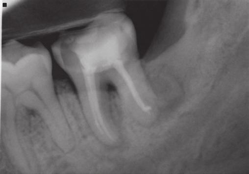 clinical photos of the mandibular left second molar of case 3.