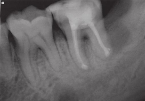However, when the patient visited our clinic for a 3-month follow up, the tooth