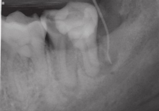 The results of a periodontal pocket probing were within normal limits.