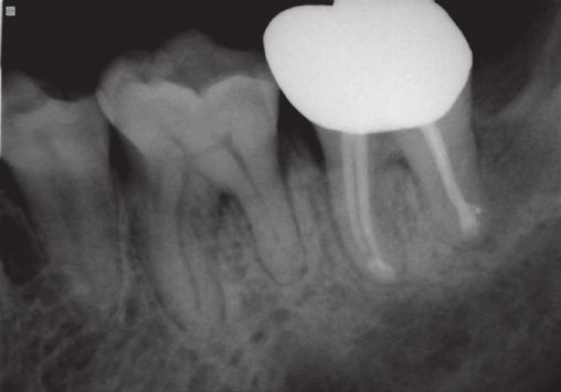 endodontic lesion.