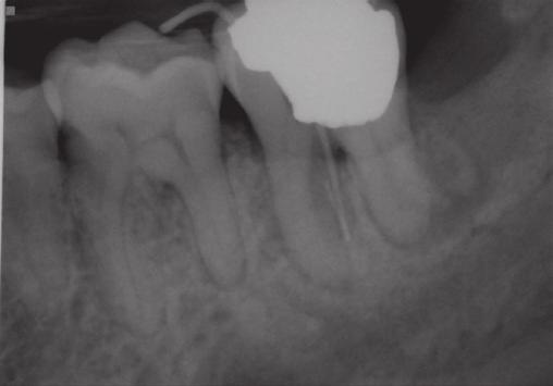 (f) Postoperative radiographs of #37 after canal filling; (g) and (h) CT views