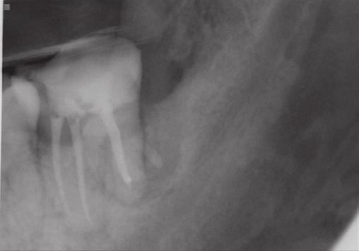 extracted second molar for intentional replantation.