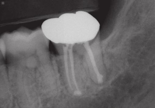 periapical radiograph at a 1-year routine check-up; (m) and (n) A periapical