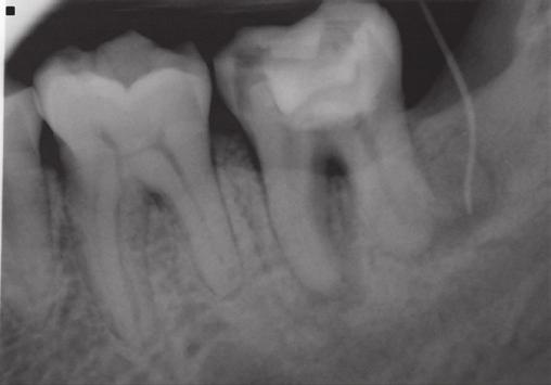 Total tooth fragment removal was confirmed with periapical radiographs (Figure