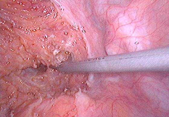 Laparoscopy in the Management of Colorectal Cancer http://dx.doi.org/10.5772/56913 111 The use of laparoscopic stapler requires multiple firings to complete distal rectal resection.
