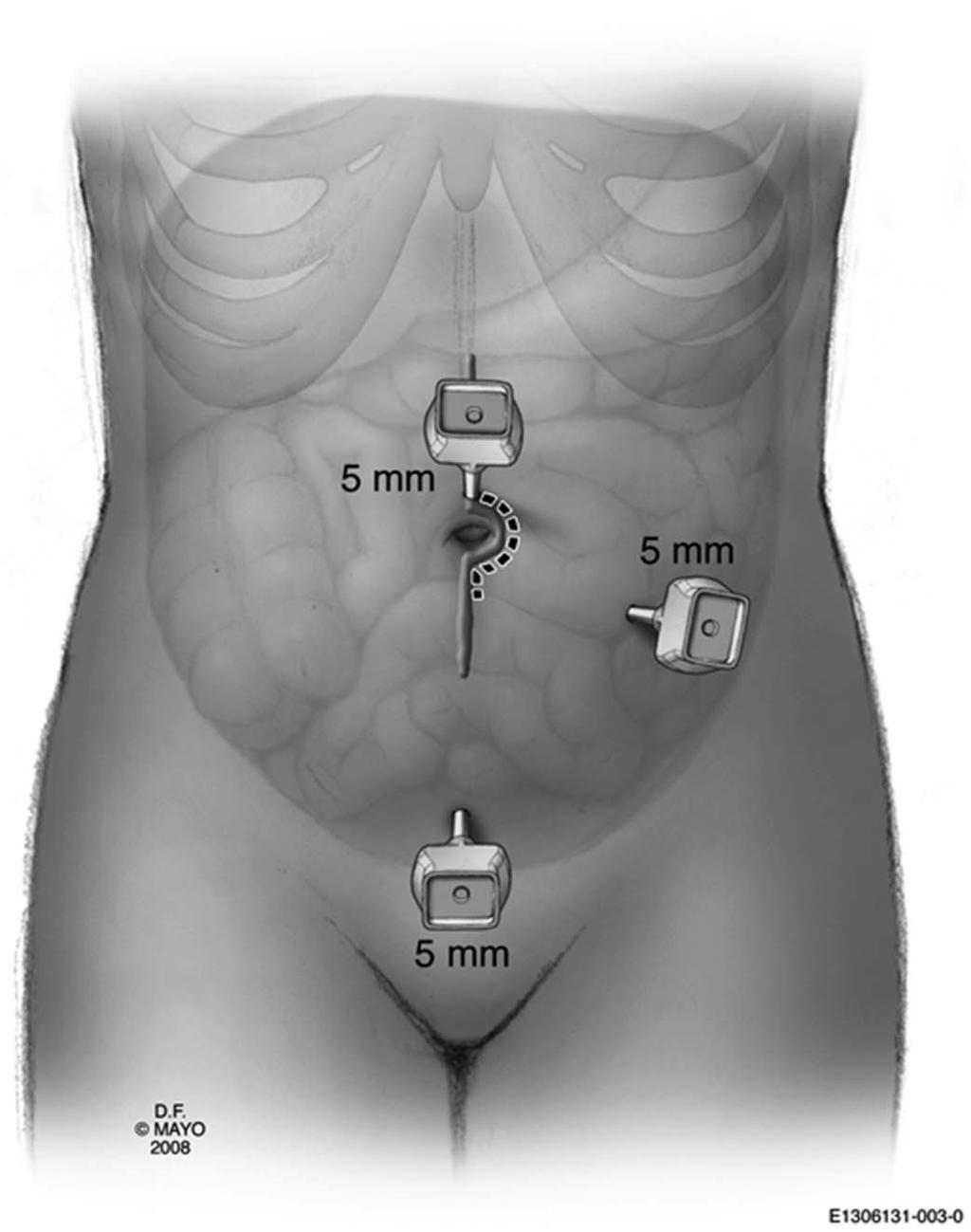 Holder-Murray et al Inflamm Bowel Dis Volume 21, Number 6, June 2015 FIGURE 1. MIS approach to laparoscopic ileocolic resection.