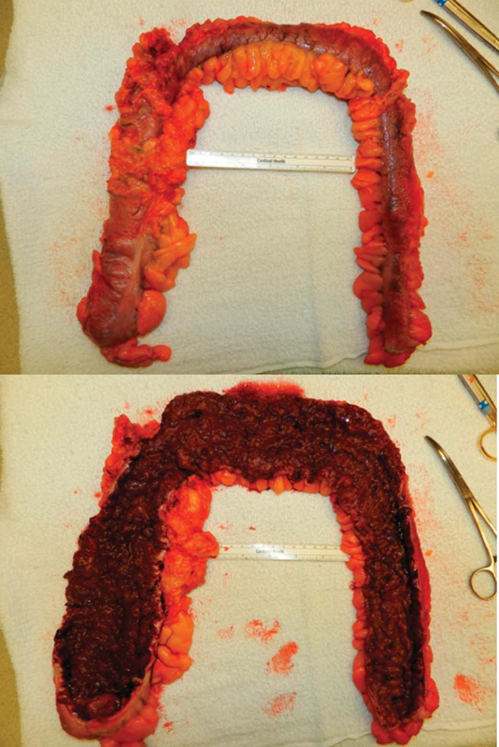 Inflamm Bowel Dis Volume 21, Number 6, June 2015 Minimally Invasive Surgery FIGURE 4. Laparoscopic total abdominal colectomy for CUC gross specimen. Pseudopolyposis with thickened bowel wall.