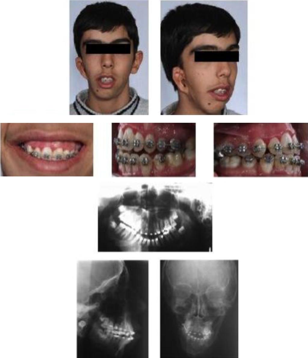 Figure 5. Pre Orthognathic Surgery Documents Then, post-surgical orthodontic treatment was performed for about 3 months.