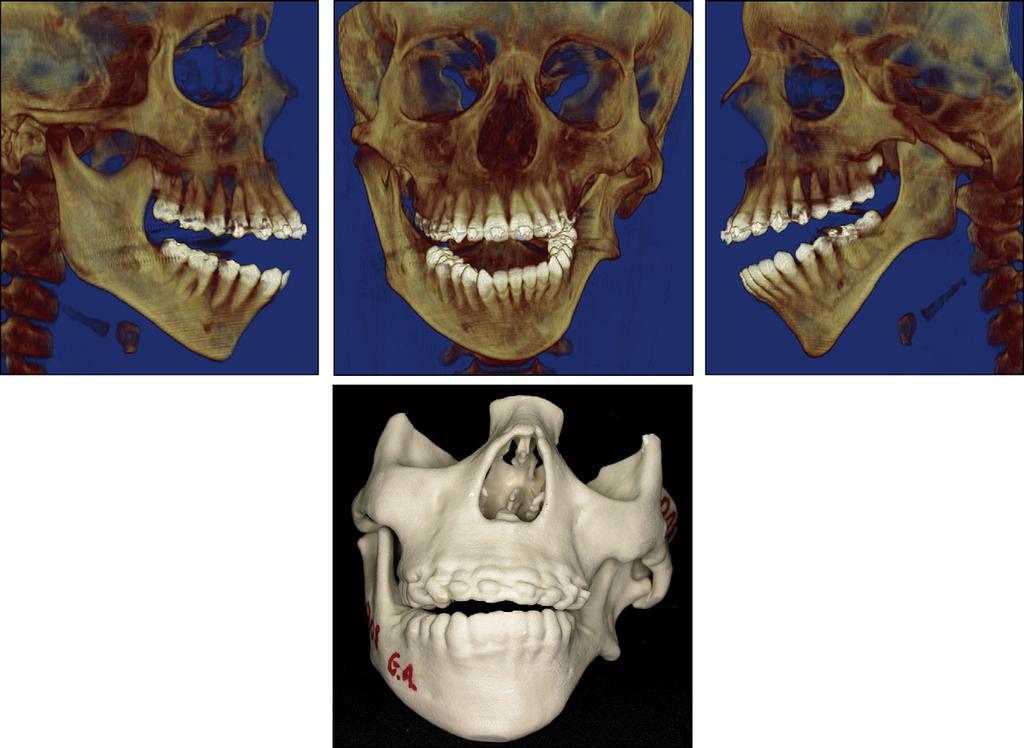 Zanardi et al S133 Fig 6. Preoperative tomographic 3-dimensional reconstructions and prototyping models. Table.