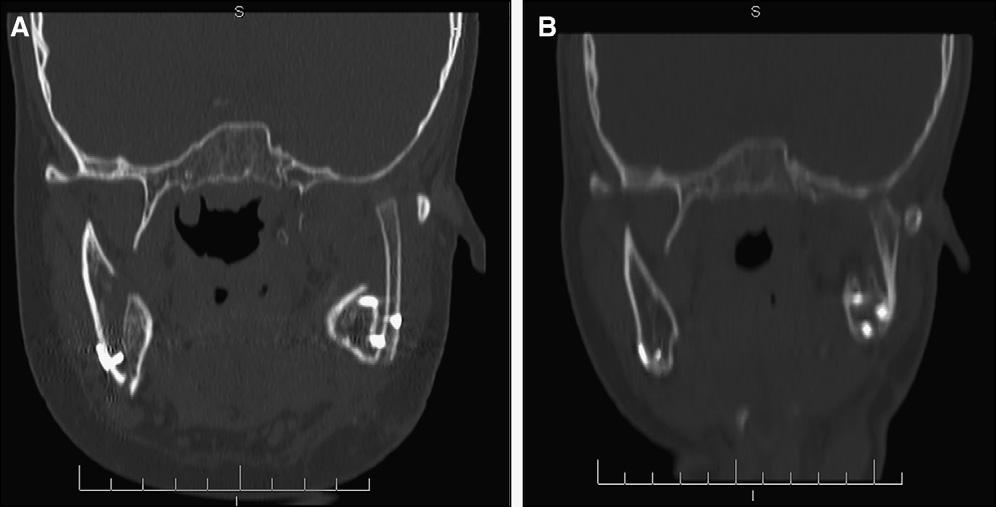 Zanardi et al S137 Fig 14. Tomographic images of the costochondral graft: A, immediately after surgery; B, 3 years later. Fig 15. Three-year postretention extraoral and intraoral photographs.
