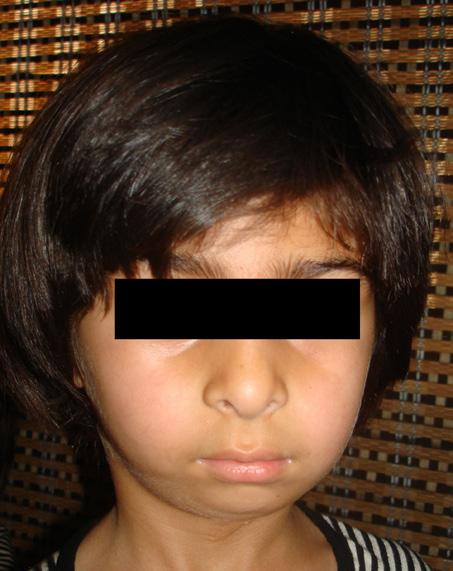 Page 6 of 7 Figure 7: (A) Deformity of a face of a 4-year-old child due to TMJ ankylosis of the left side of the face. (B) CT scan of the left TMJ showing deformity of the joint.