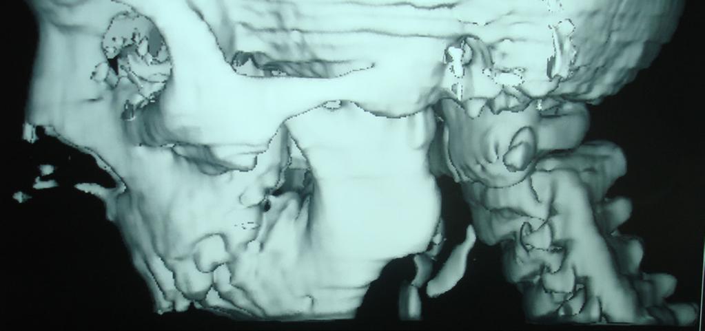 (E) Lateral oblique of the left side of lower jaw showing reconstruction of the left TMJ by chondro-osseous graft after 3 months.