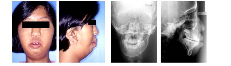 complication. The facial asymmetry of the patient dramatically improved (Fig.