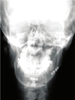 Improvement of the hypodevelopment on the right side of the face. A distraction gap filled with radiographically normal bone and the lengthening mandible resulted in improvement of the deviated chin.