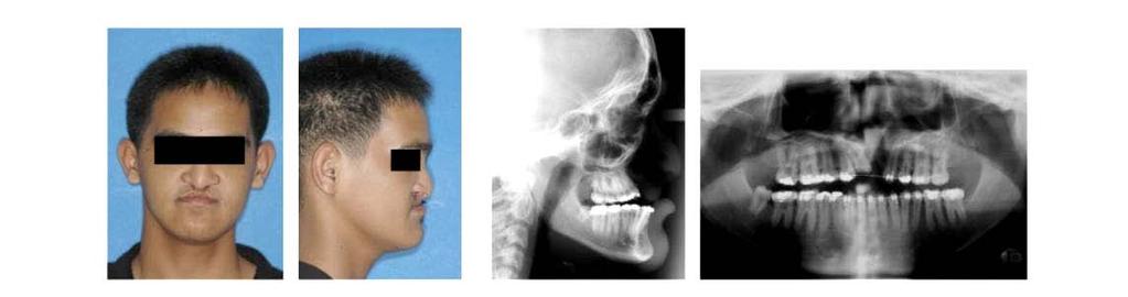 The distractor were placed after mandibular osteotomy on both sides and the mucosa was closed leaving the activation rod exposed in both buccal vestibules.