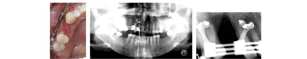 B4 - B7 An interdental osteotomy line between the maxillary canine and the first