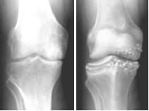 BMJ 2009; 339: b2844 Worsening radiographic osteoarthritis Kellgren and Lawrence grade (radiological assessment of OA and