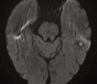 1A 1B 1A B T2 FLAIR and T1w postcontrast image show a lesion in the left temporal lobe with surrounding edema and moderate mass effect.
