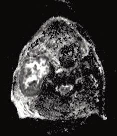 properties with the Apparent Diffusion Coefficient (ADC). Case 2 72-year-old male patient with mass tumor in the right submandibular space.