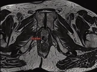 Oncological Imaging Clinical Case 4 68-year-old man with prostate cancer.