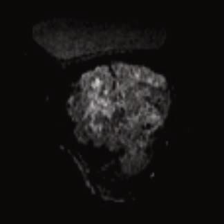In postcontrast T1 images, the tumor shows irregular, enhancement from