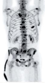 Bone scan 18F-choline-PET NaF-PET BS