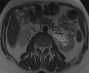 nodal, visceral) MRI