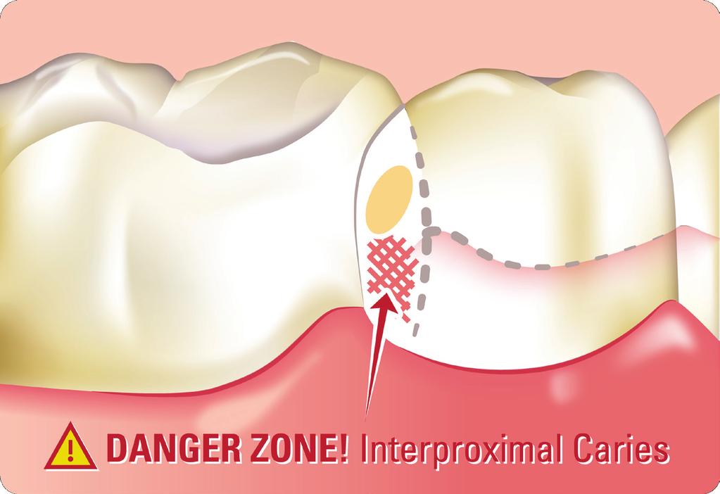 The Most Difficult Area To Clean Teeth Contact Area Interproximal Caries occur most often directly