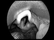 Dexamethasone administration and postoperative bleeding risk in children undergoing tonsillectomy. Arch Otolaryngol Head neck Surg. 2010;136:766-772.