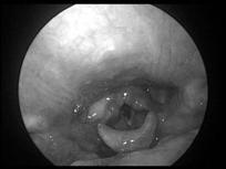 AJR 179:503-508,2002 // Radiology 223:176-180, 2002 SITE SPECIFIC SURGICAL INTERVENTIONS Lingual tonsil hypertrophy