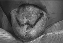 MACROGLOSSIA Absolute macroglossia Trisomy 21 Beckwith-Wiedemann Lymphatic VM Relative macroglossia Usually seen with obesity May