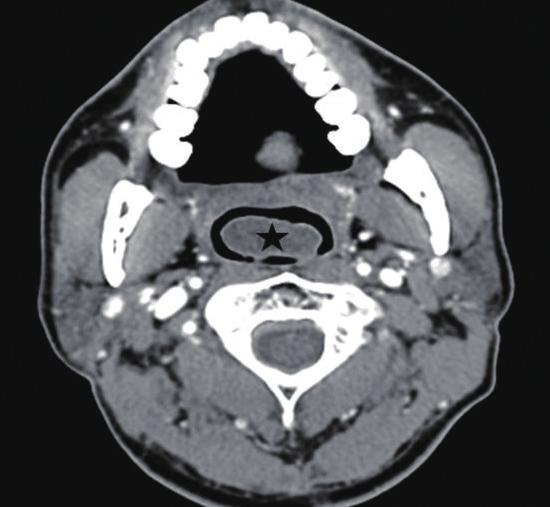 Endoscopic and radiologic findings of a nasal mass presenting as mild, moderate, or severe OSAS are shown in Figs. 1, 2, and 3, respectively.