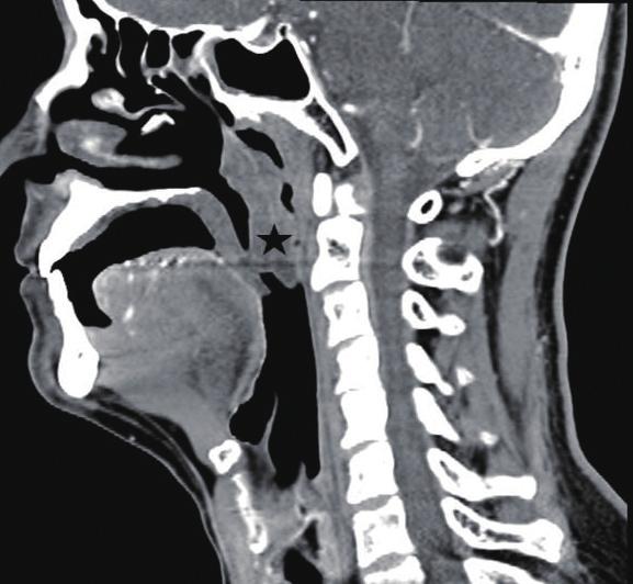DISCUSSION The results of this study suggested that a large nasal mass occupying the nasopharyngeal space may result in OSAS, and nasal surgery alone may be an effective treatment for such OSAS