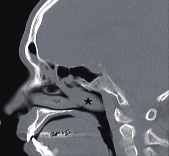 Although the exact pathophysiologic mechanisms linking nasal obstruction and SDB are not completely understood, there are several potential mechanisms, including augmented airway resistance, change