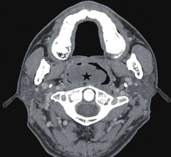 IT: inferior turbinate, S: septum, black asterisk ( ): nasal mass. D occupied most of the nasopharyngeal space. This study has several important limitations.