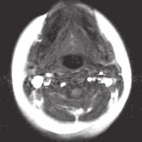 mandibular length Overbite Superior hyoid bone position Smaller dental arch Cozza et al.